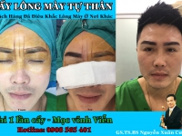 Bác sĩ quốc tế cấy lông mày có bảo hành tại Việt Nam
